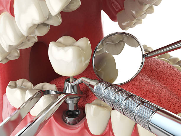 Best Emergency Tooth Extraction in Tamarac, FL